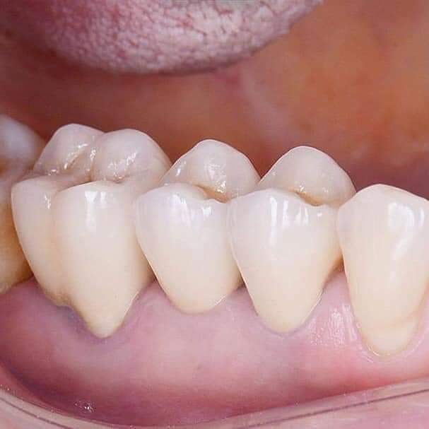 Lấy tủy răng - Nha khoa An Khang