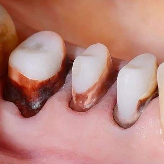 Dịch vụ Lấy tủy răng nhà khoa An Khang